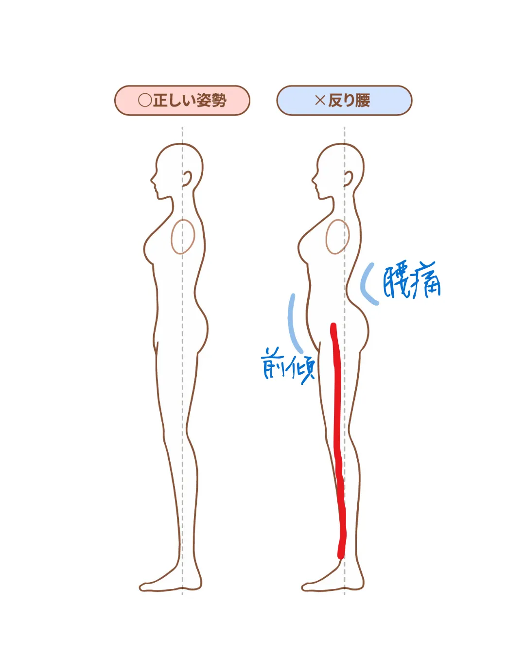 【必見】反り腰・脊柱管狭窄症改善マニュアル｜都城市　奏でる整骨院